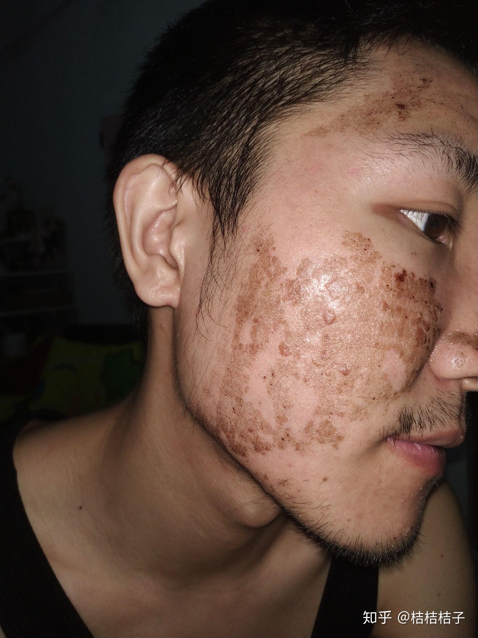 激光点阵对痘坑有效果吗