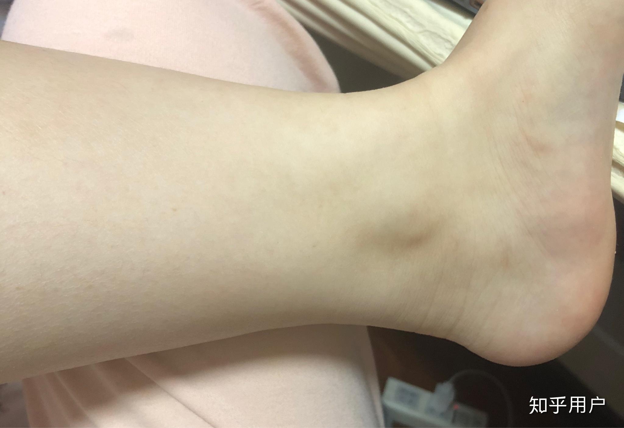 没有脚踝是怎么样一种体验