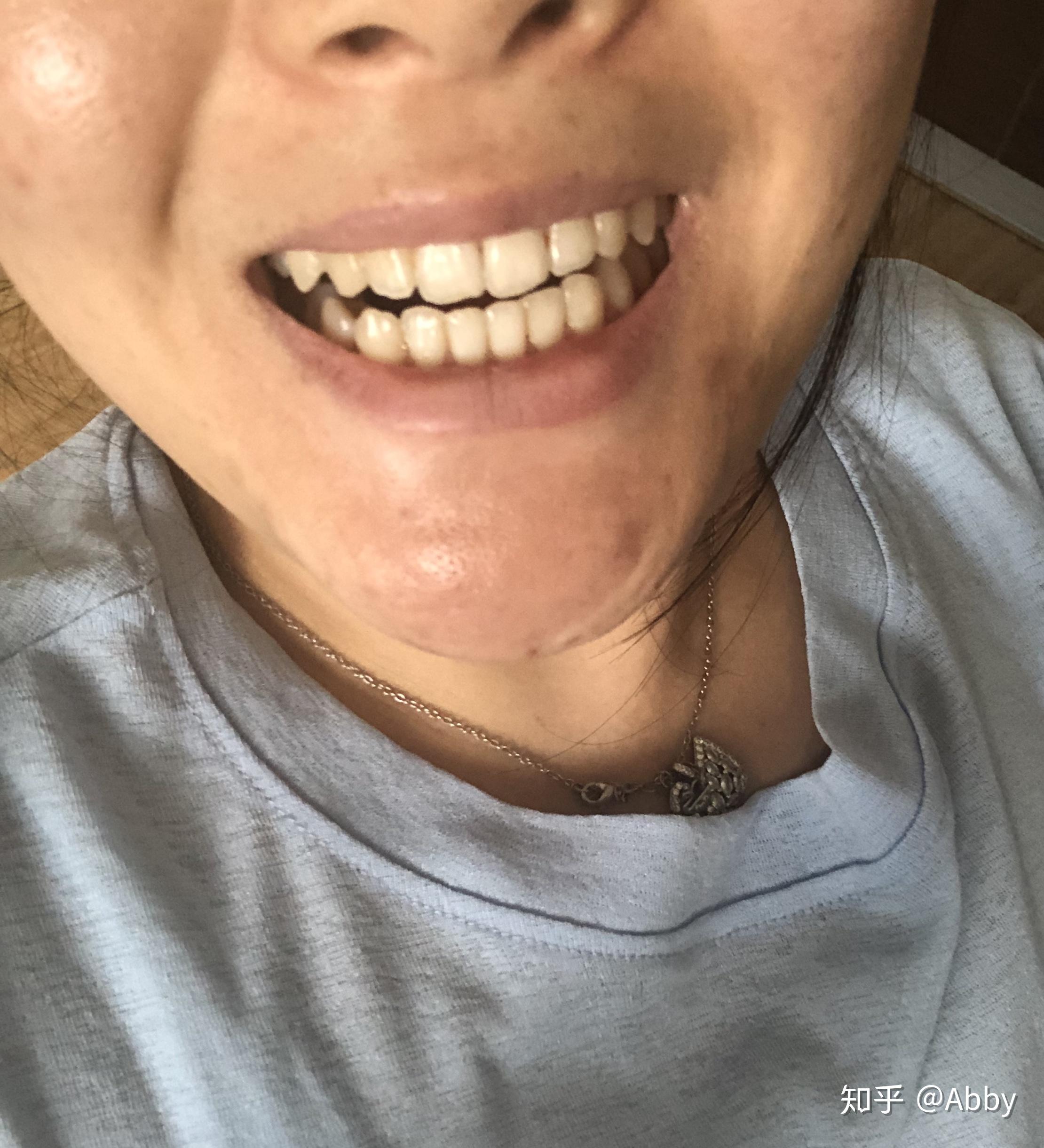 拔牙后会不会因为牙槽骨被吸收而不能植牙了