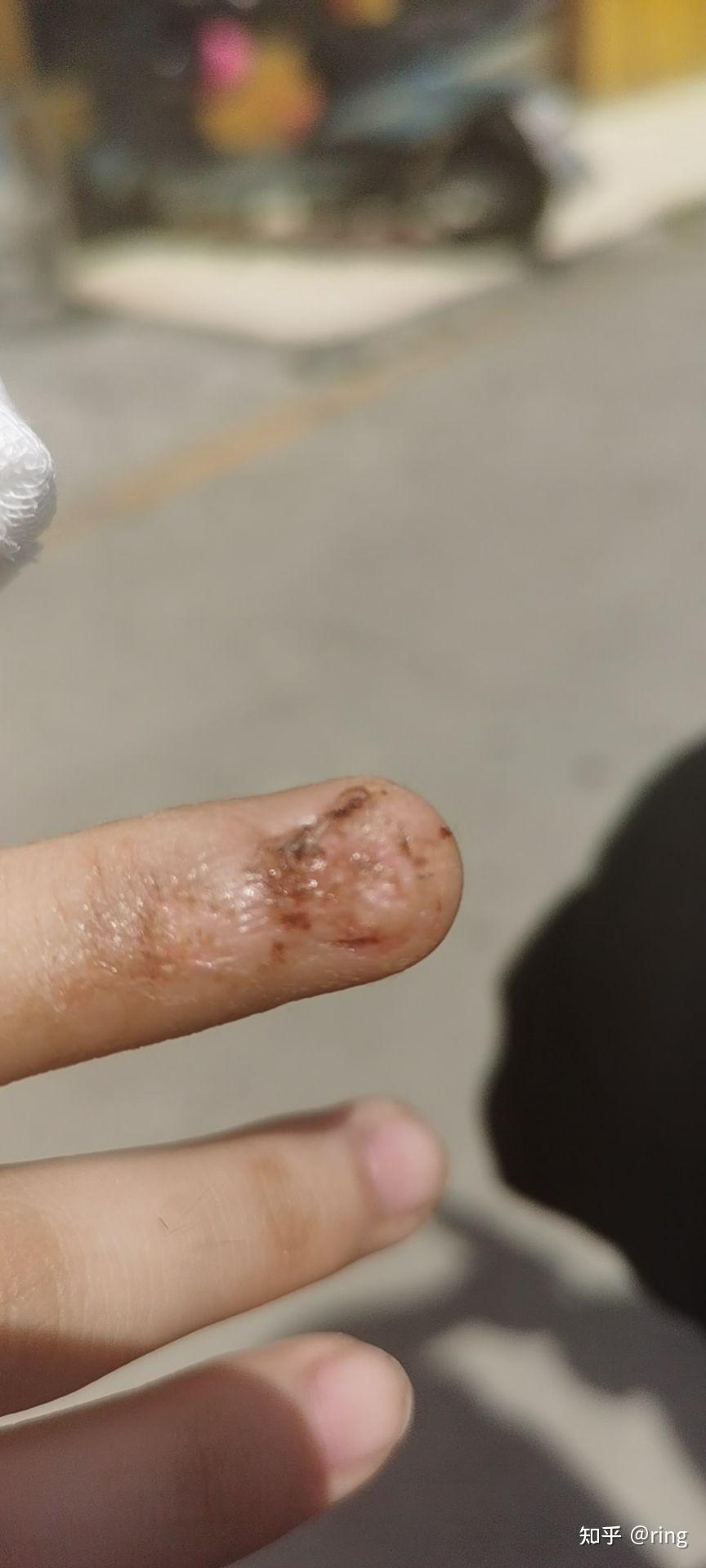 指甲盖掉了会重新长出来吗,需要多久?