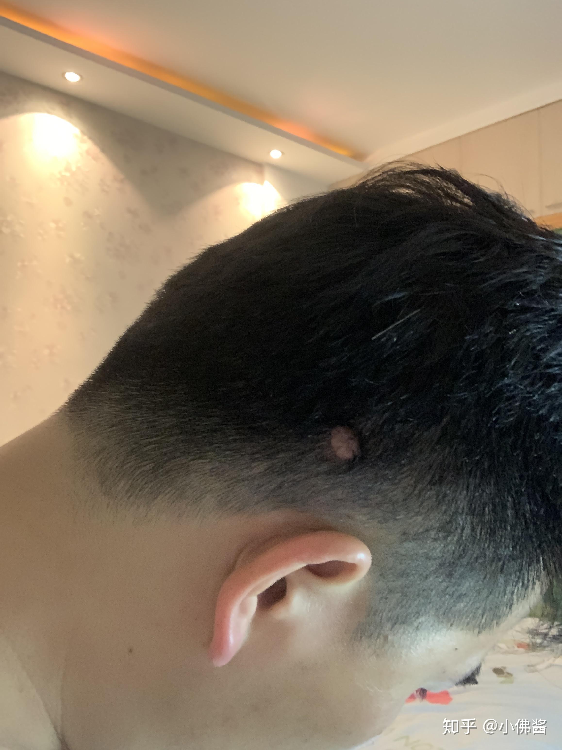 后脑勺长了一个肉疙瘩? - 知乎