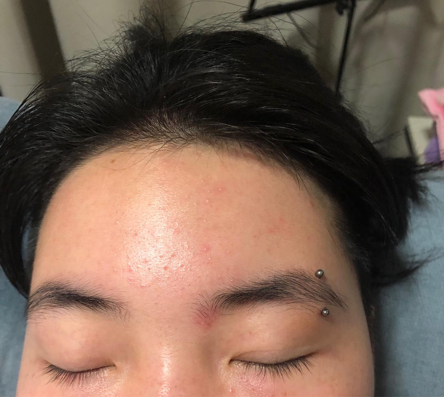 隔一段时间额头和眉心就会长闭口粉刺和小痘，有点痒，敏感肌，好像一到快月经时就这样，求助如何调整? - 知乎