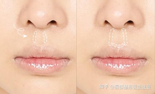 人中长该怎么办?丰唇能够缩短人中吗?人中缩短效果好不好? - 知乎