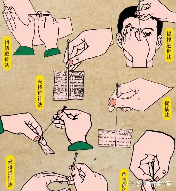 针灸的作用！ - 知乎