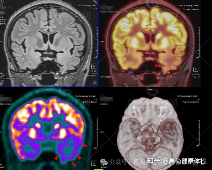 PET/CT-MR联合显像寻找致痫灶一例 - 知乎