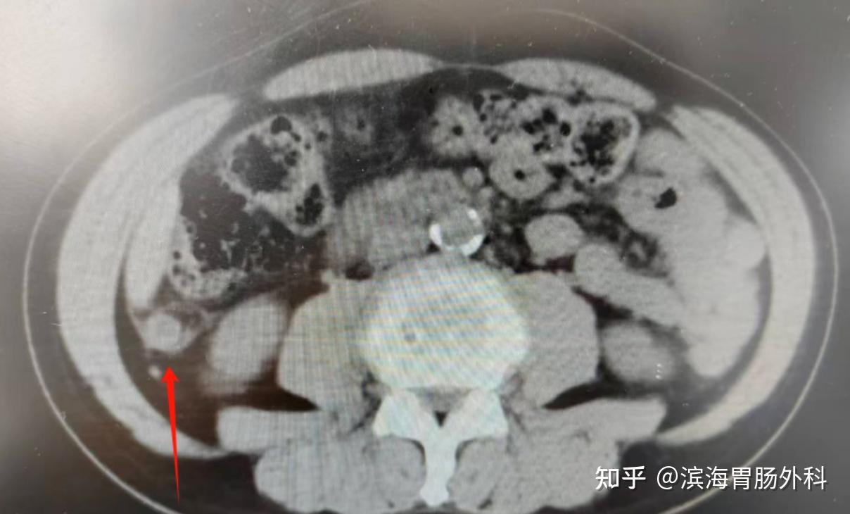 阑尾炎的非手术治疗以及腹膜后阑尾炎 - 知乎