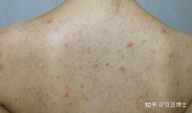 背部长痘痘是什么原因呢? - 知乎