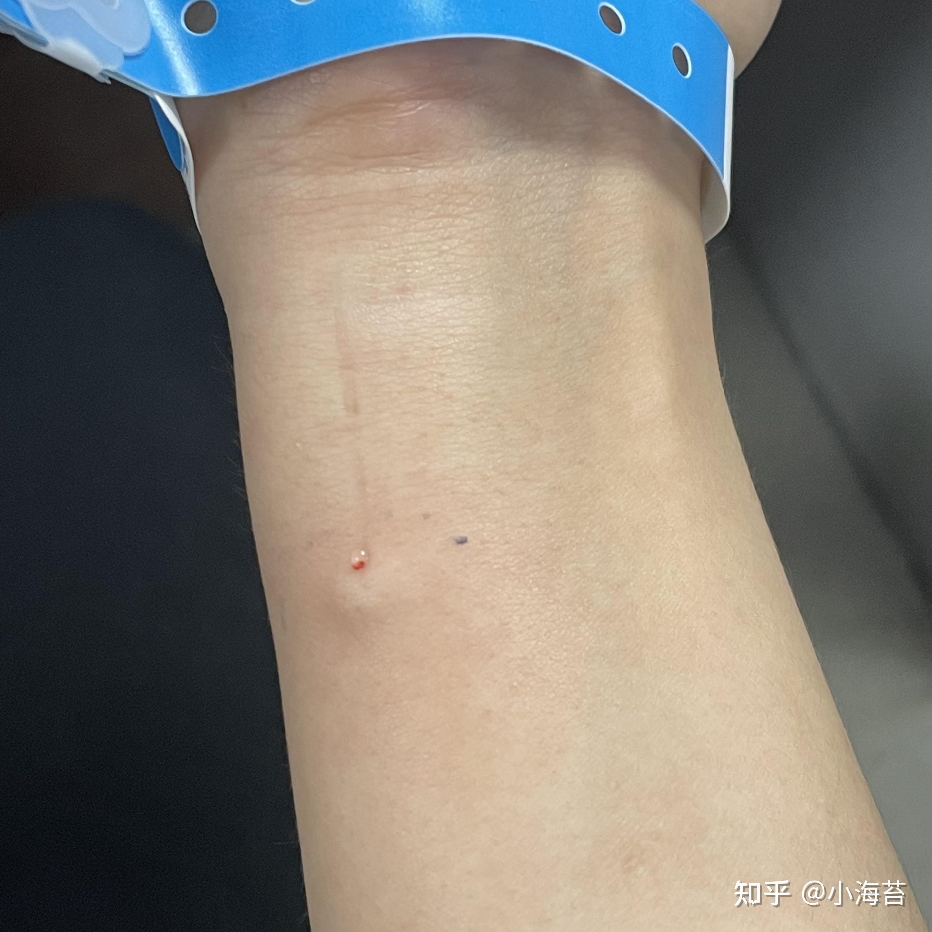 皮试有多痛?