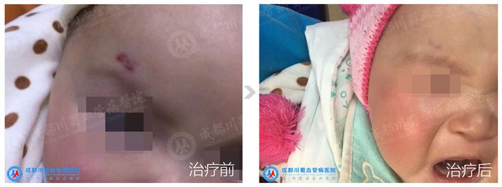 如何诊断和治疗血管瘤? - 知乎