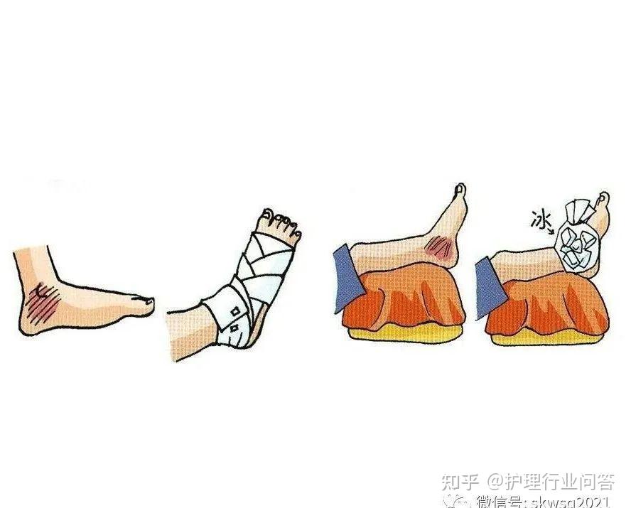 意外扭伤了怎么办? - 知乎