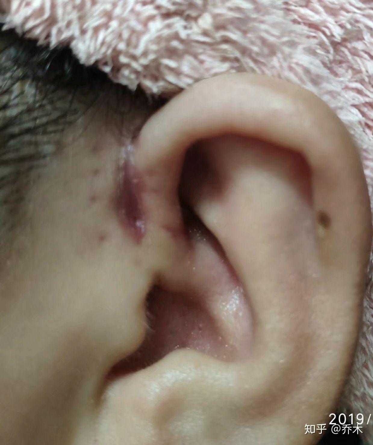 耳朵上隔壁有个小洞,是天生就会这样的,那个小洞有时还会流水出来