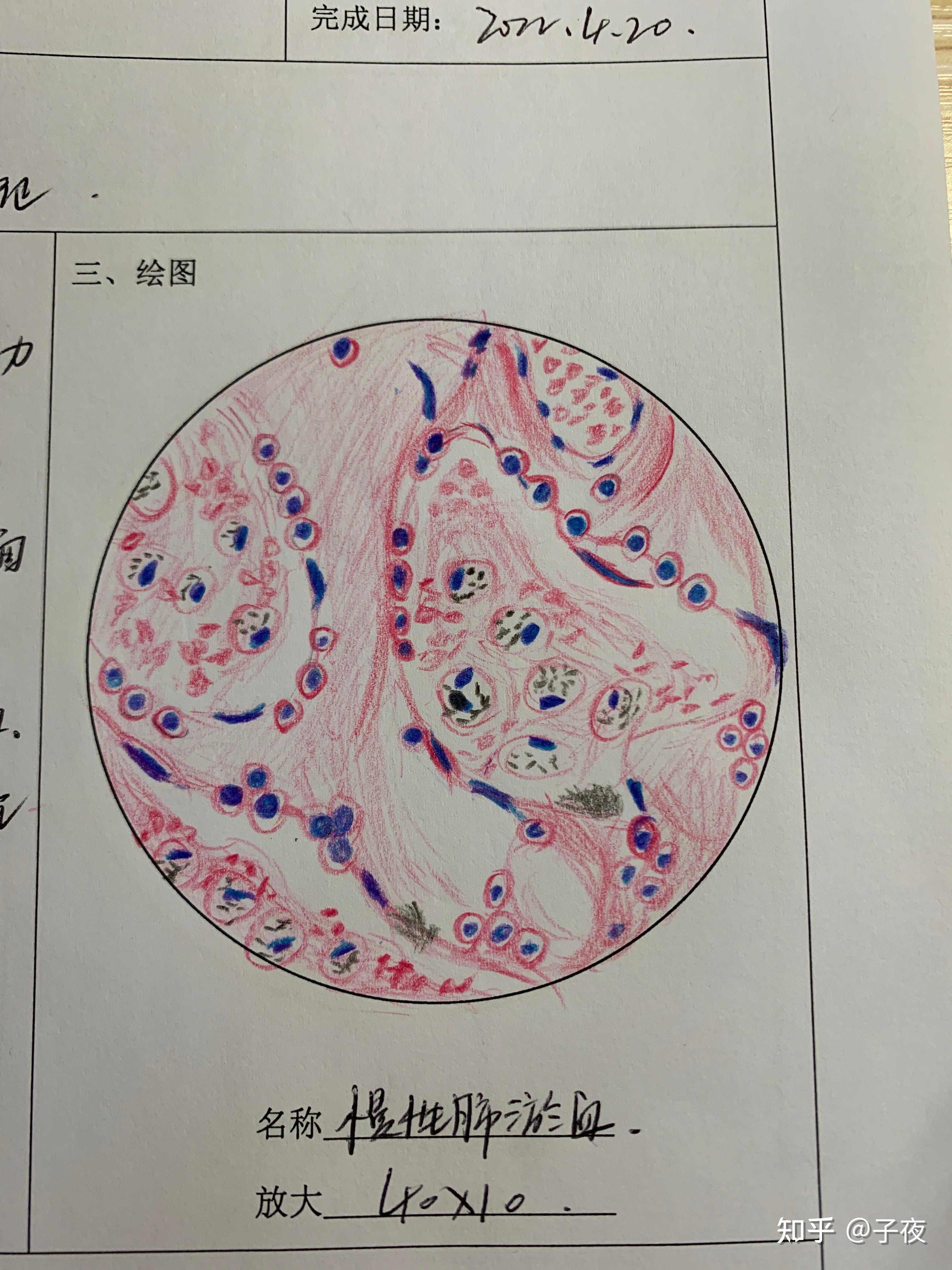 谁有慢性肺淤血高倍镜红蓝手绘图片吗