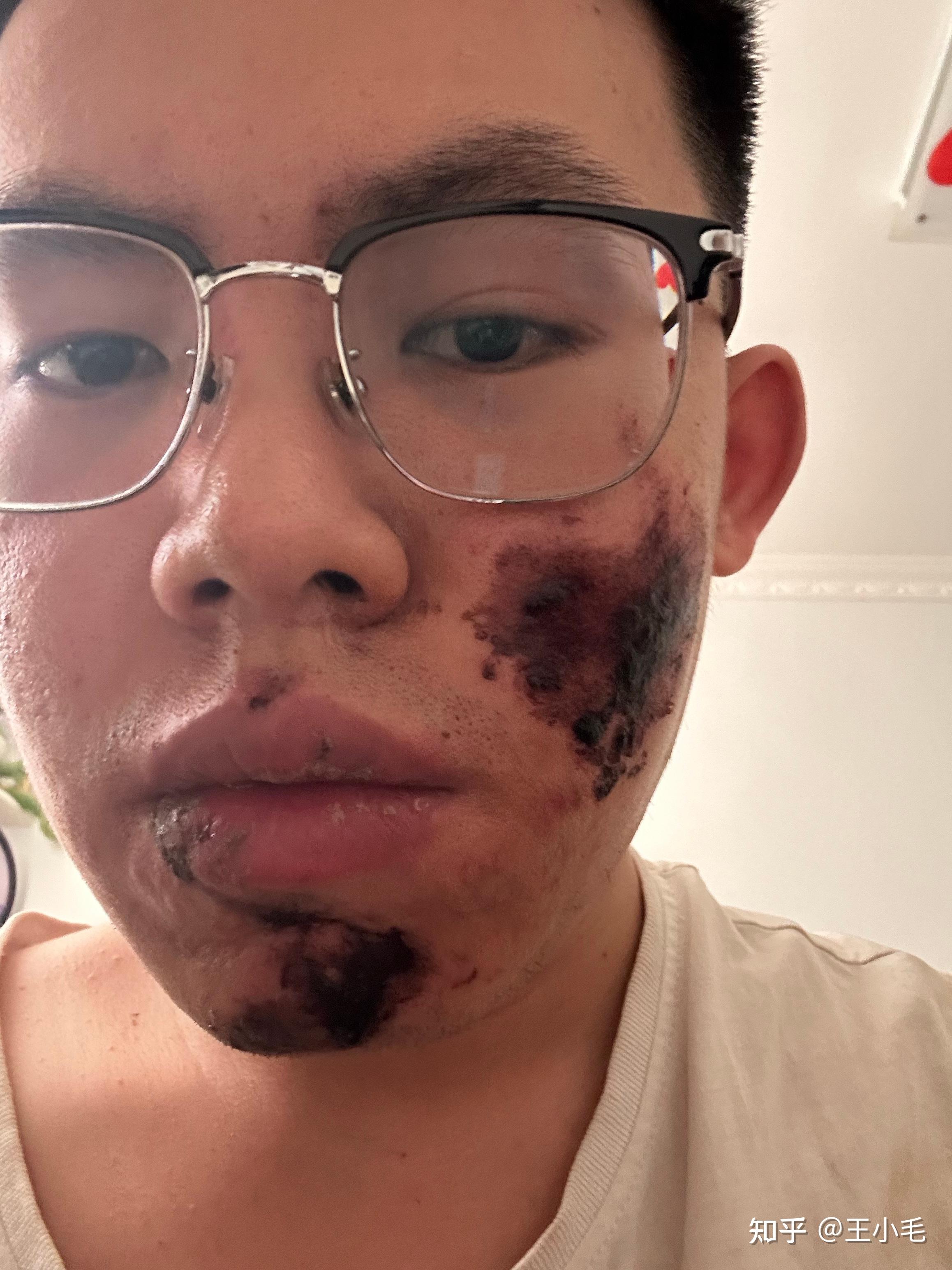 骑电动车遇到沙子路摔倒了,脸部被擦伤,记录一下,会一直发后续,希望不