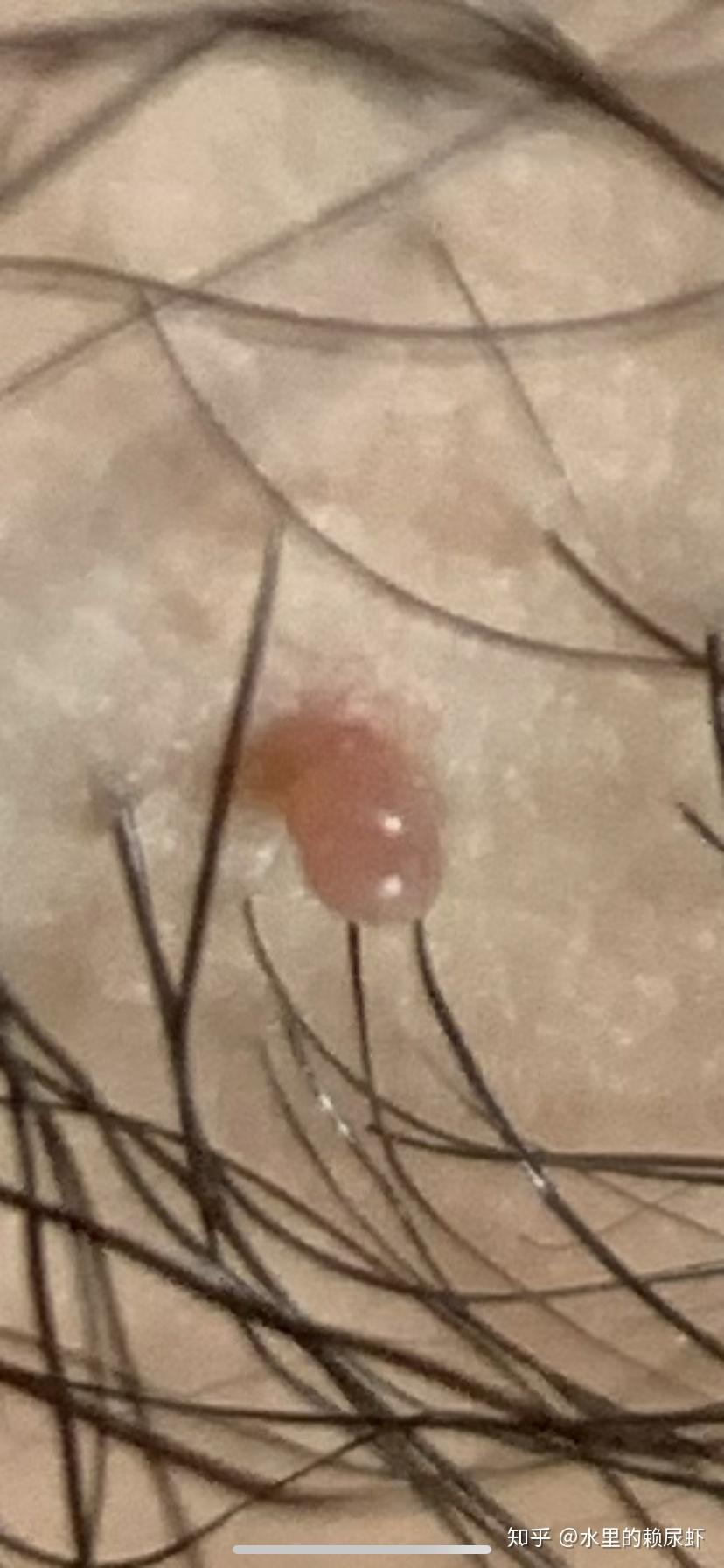 胳肢窝下面十几厘米处长了个小肉粒今天洗澡发现的不