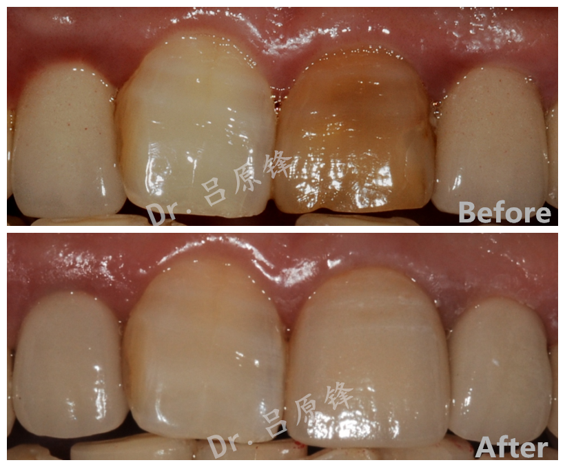 全瓷牙门牙做一颗是无法和旁边的牙颜色一致的么