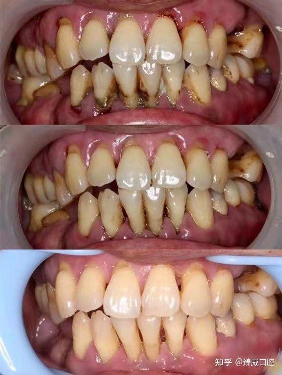 吸烟对牙齿的危害有多大