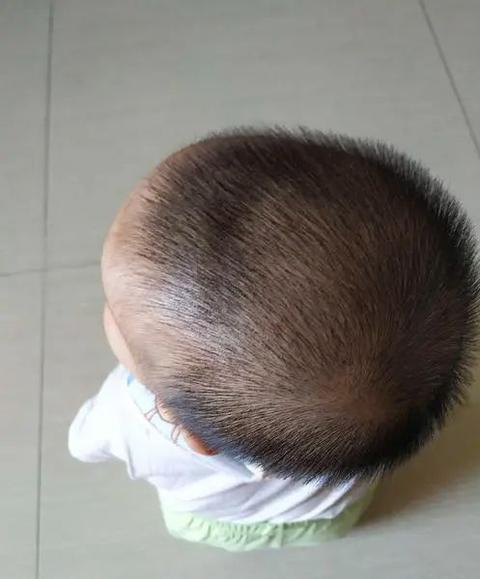 婴儿脑积水 - 知乎