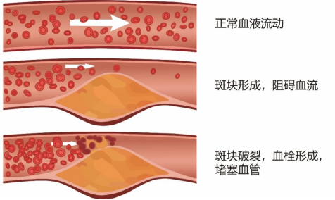 阿哌沙班年销千亿背后:抗凝药进化之路,解锁血栓形成与凝血因子Xa密码 - 知乎