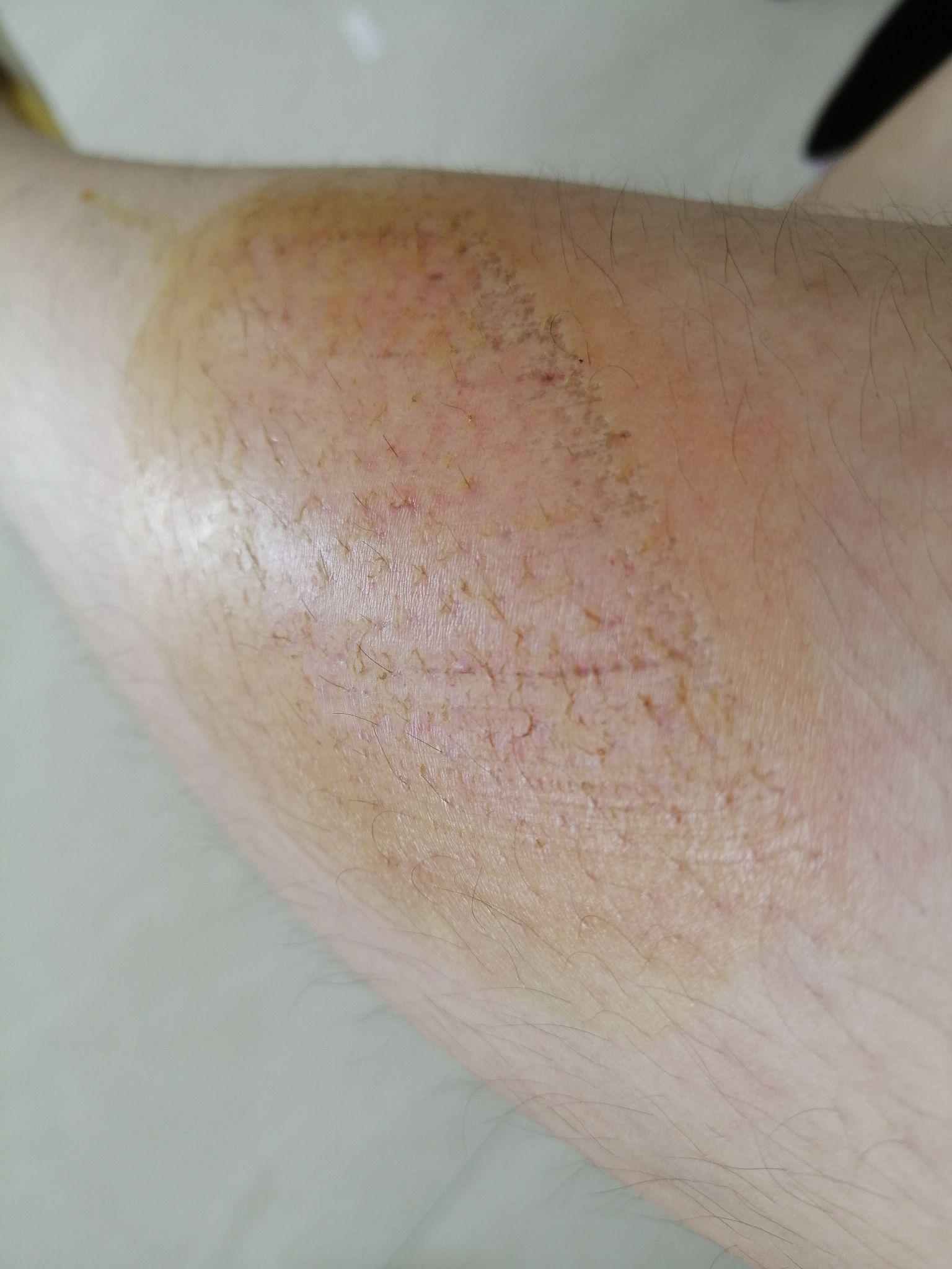 骑车侧翻膝盖摔伤破皮怎么处理伤口怎样才能不留疤