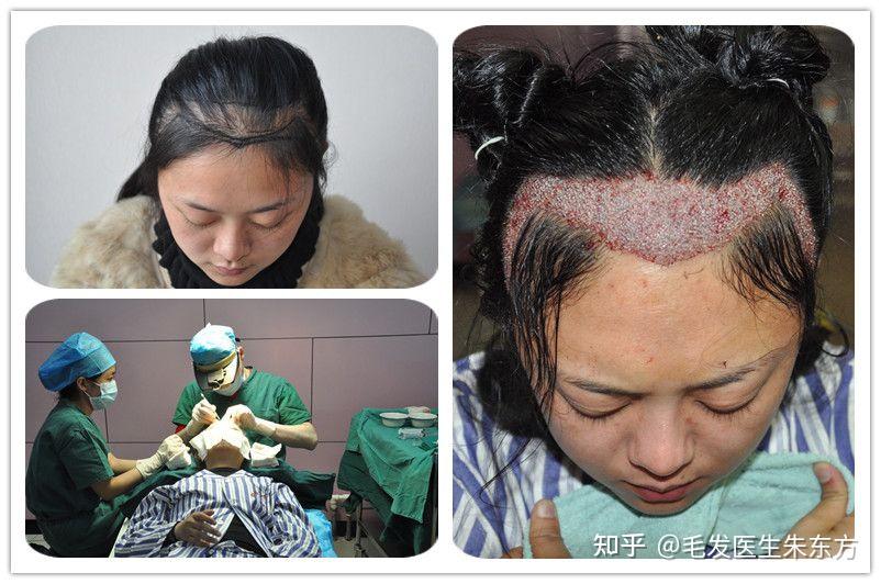 女性头顶稀疏、发缝变宽是什么原因导致的？该怎么办？ - 知乎
