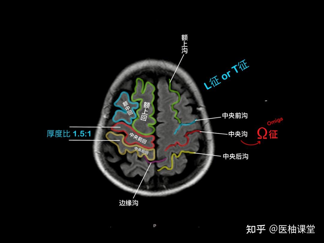 头颅MR阅片手绘(精华版) - 知乎