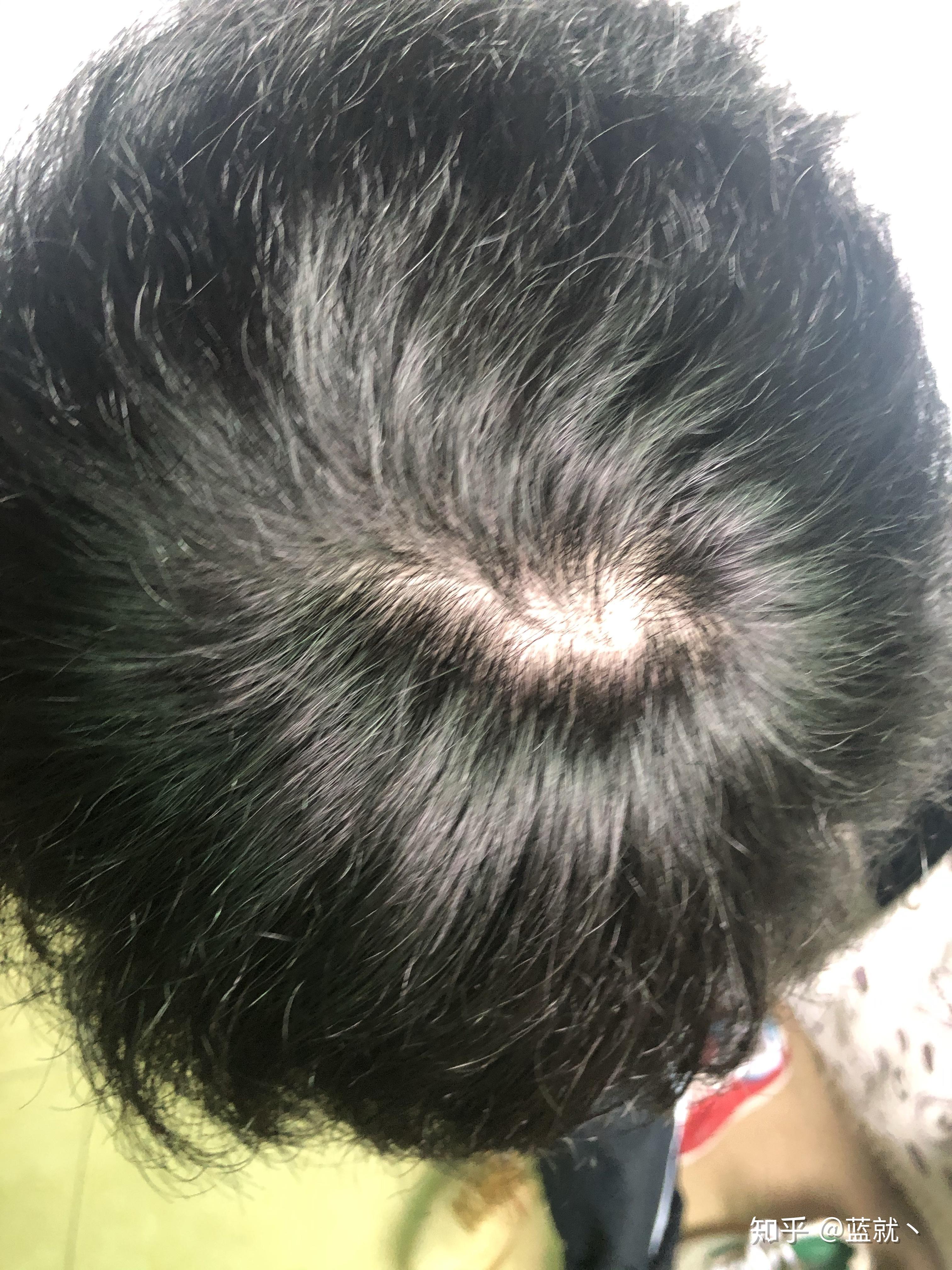 什么样子的发旋是正常的啊? - 知乎