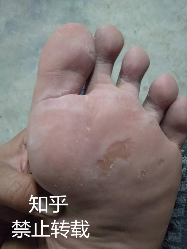 足底疣正确根治方法