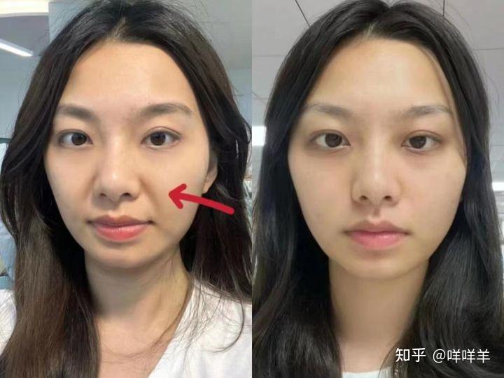 宝妈都是怎么去法令纹的,有没有简单又有效的方法? - 知乎