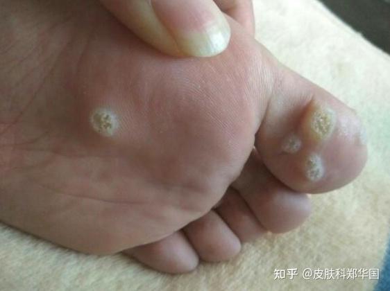 跪求治跖疣的方法,一直在涂药好不了,还越长越多 ?