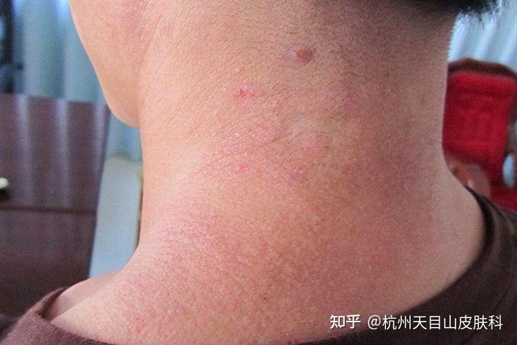 脖子上突发红疹瘙痒?专家揭秘常见病因及应对策略 - 知乎