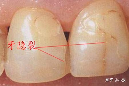 门牙裂了条缝怎么办? - 知乎