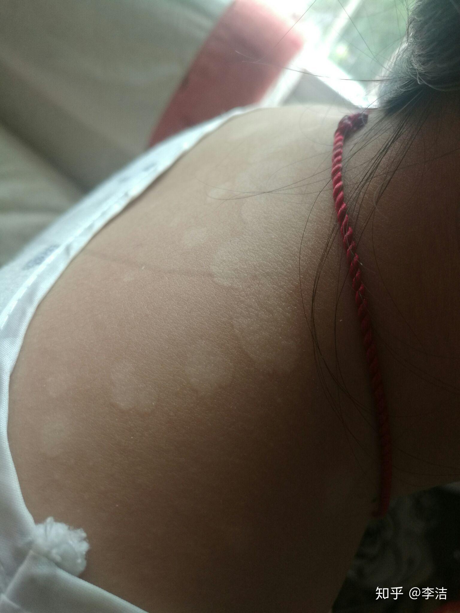 脖子到肩膀长白色斑是什么.