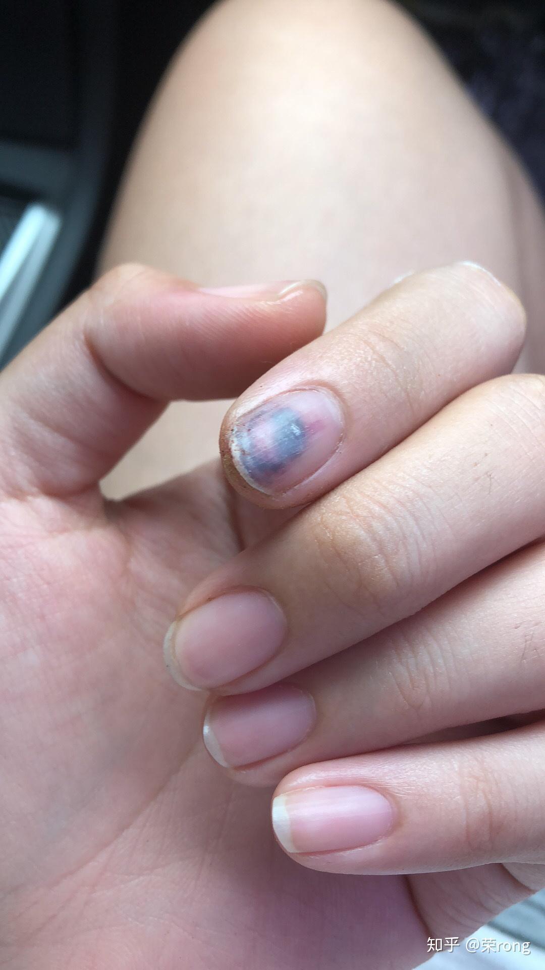 手指被门夹到飙泪是种怎样的体验