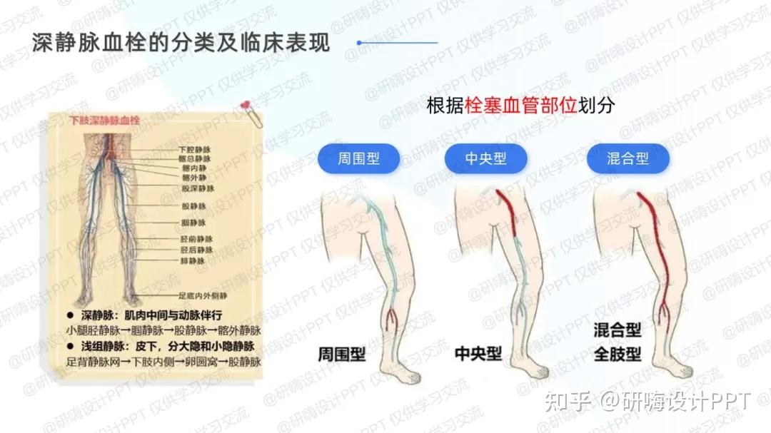 下肢深静脉血栓的预防和护理新进展案例分享