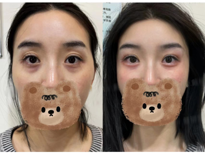 抗衰回报率最高的眼周,怎么打才最有效?进阶版的眼周固定提升打法,提升紧致的同时还保留了平整度! - 知乎