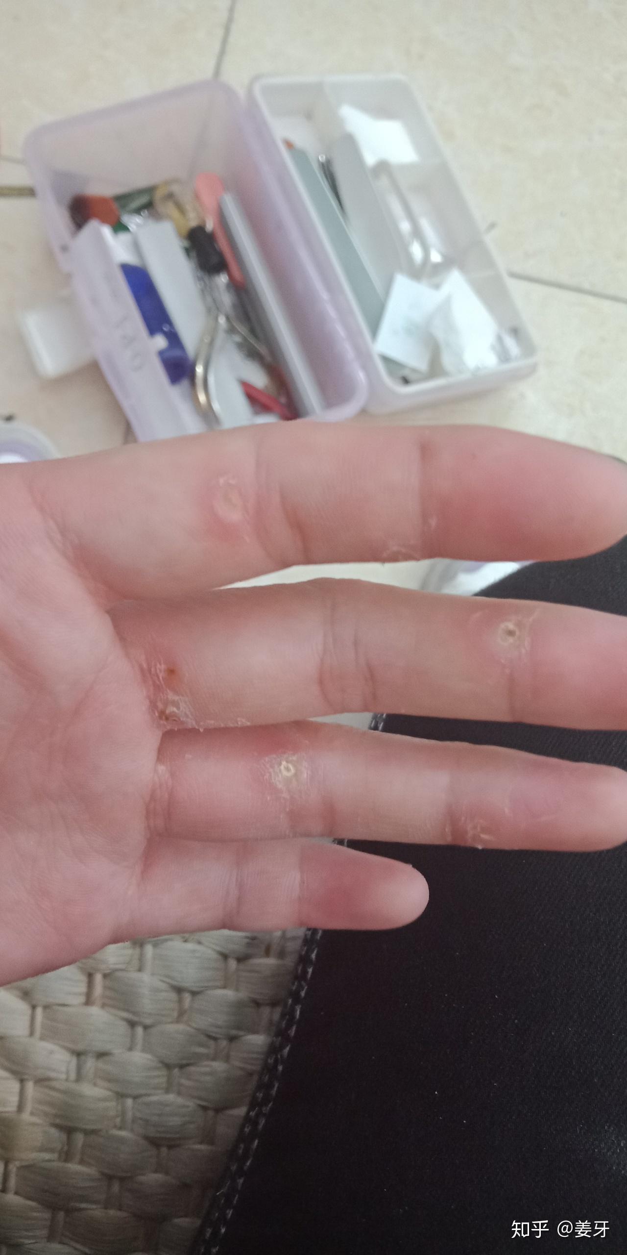 手上长的瘊子怎么治疗