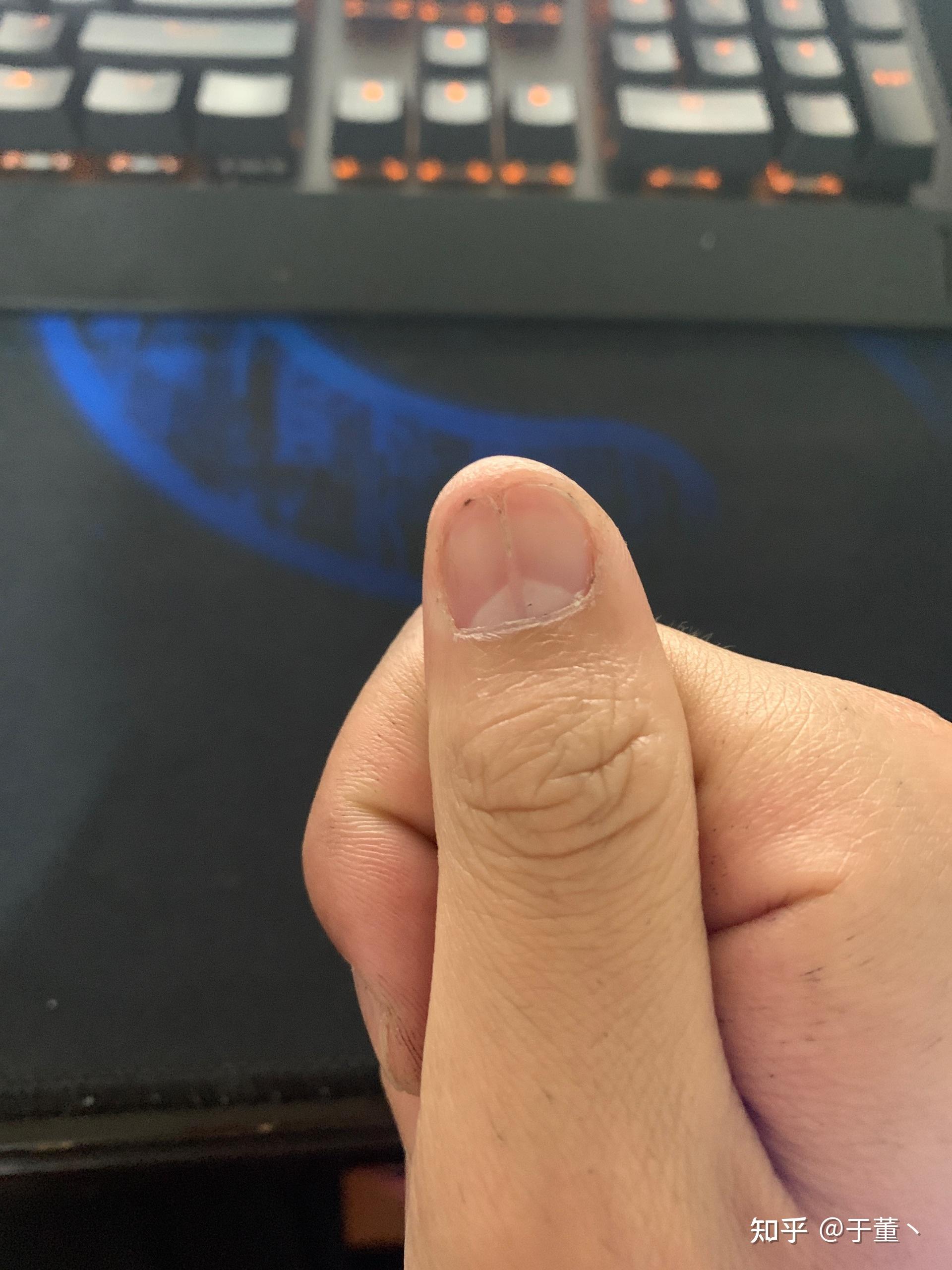 如图为什么指甲总会长出一条裂纹新长出来以后前端又会慢慢裂开中间有