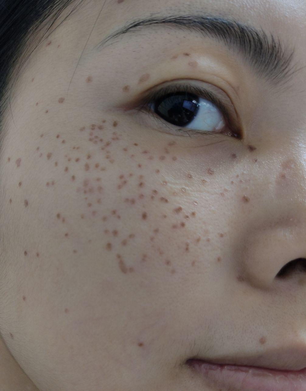 点斑后的恢复期? - 知乎