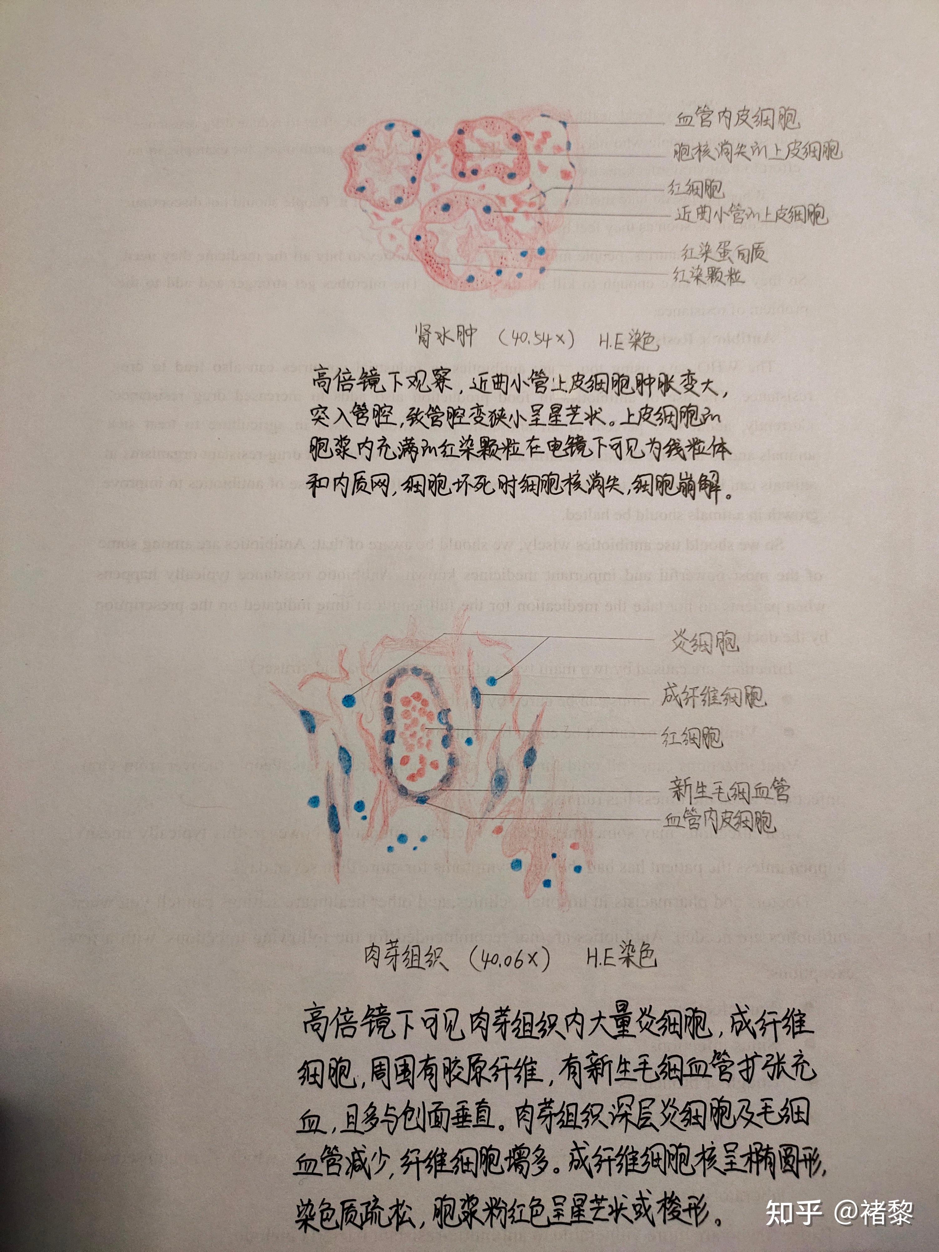 有没有人有病理的结肠腺癌红蓝铅笔手绘图啊? - 知乎