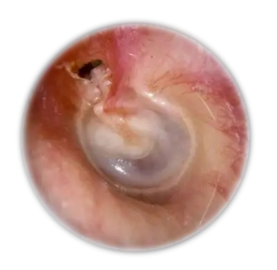 "见缝就生长"的胆脂瘤,是怎么形成的?