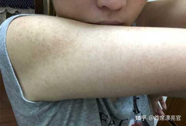毛周角化症怎么办