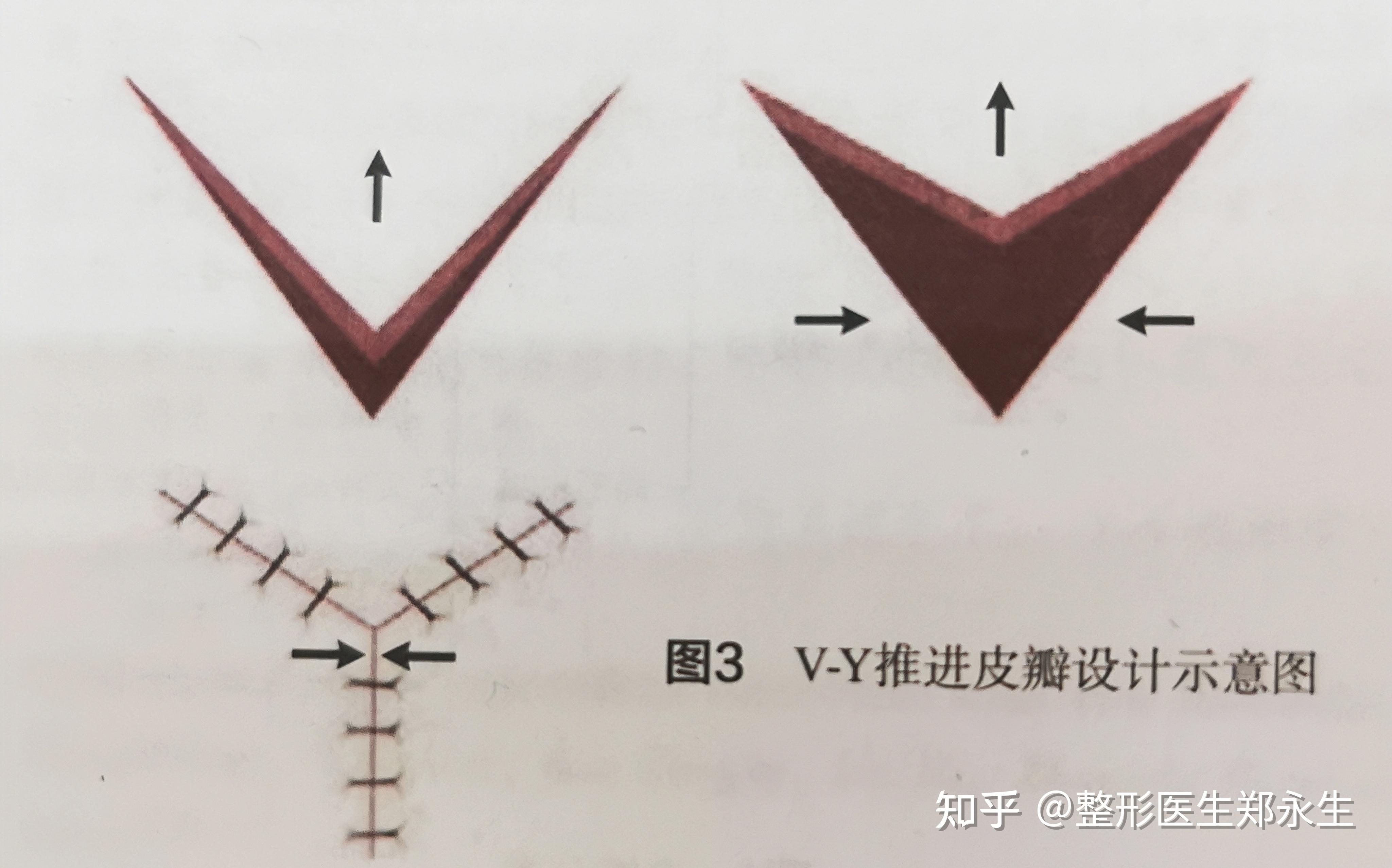 有粉丝问我,什么是V-Y推进皮瓣?是不是修复下睑时常用到的手术方法? - 知乎
