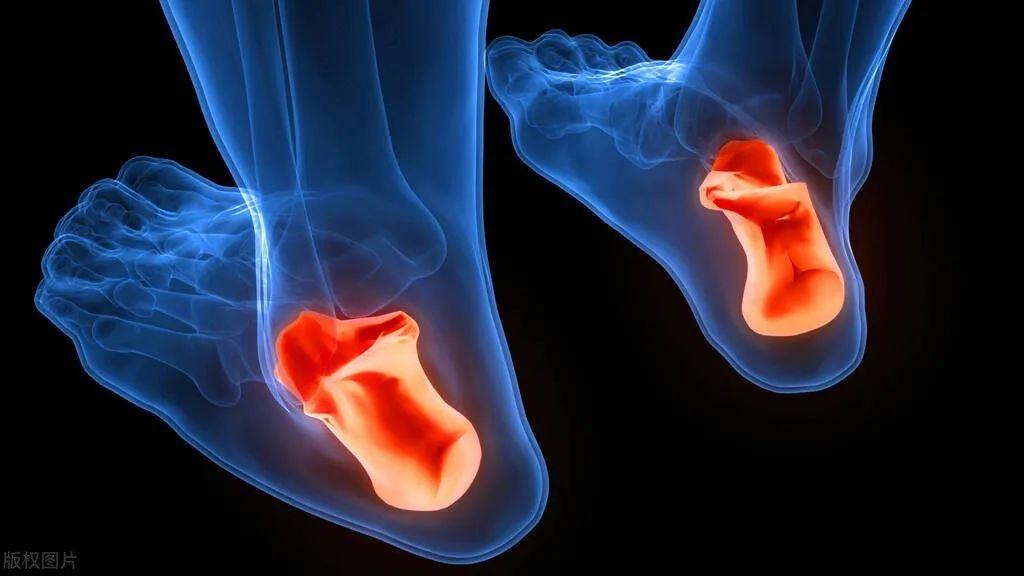 脚后跟痛，是不是长骨刺了？ - 知乎