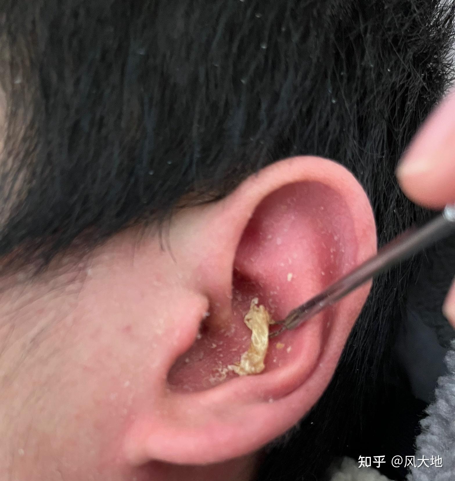 耳屎能大到什么程度