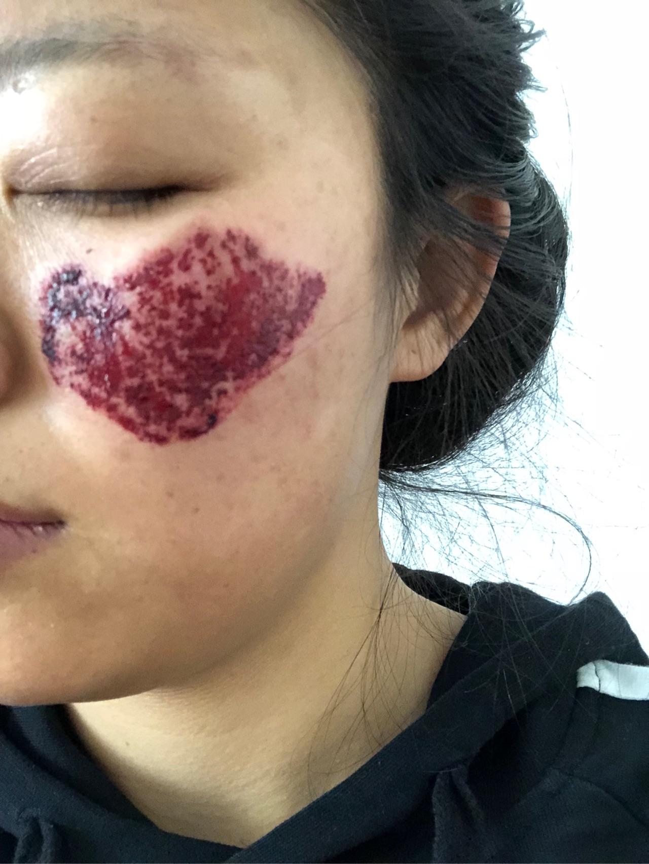 有人激光治疗过颧骨褐青色痣吗