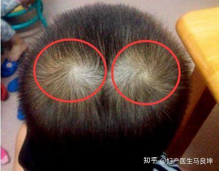 “一旋好二旋横”，旋越多越聪明？娃头上的“旋”，隐藏了大学问 - 知乎