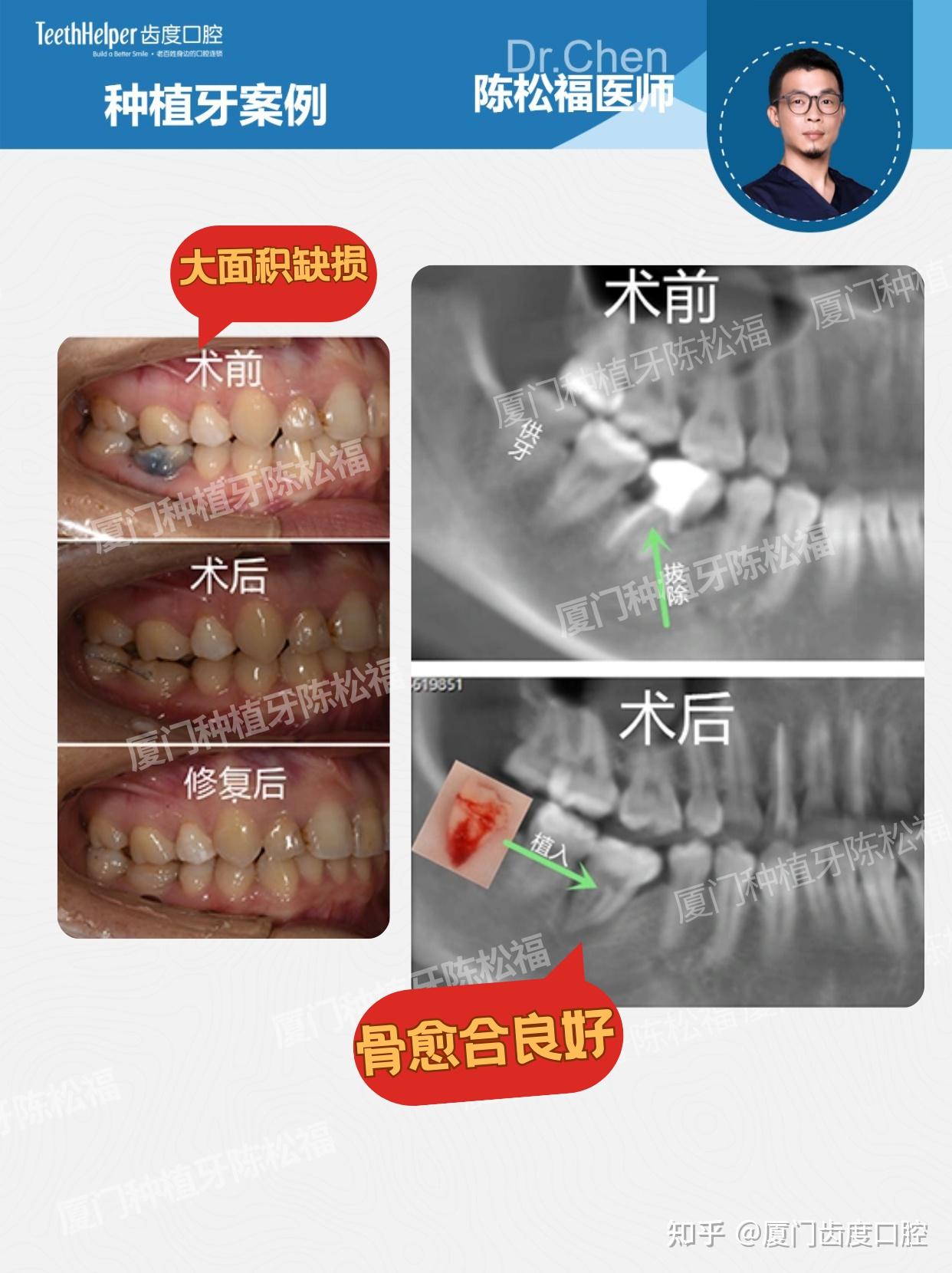 24岁根折救牙记 自体牙移植,把“自己的牙”放回原位 - 知乎