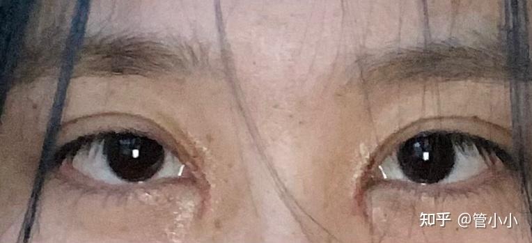 有没有内眦赘皮严重的人开眼角?急!