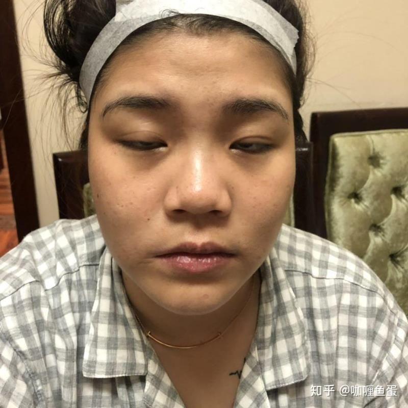 蒜头鼻怎样改善