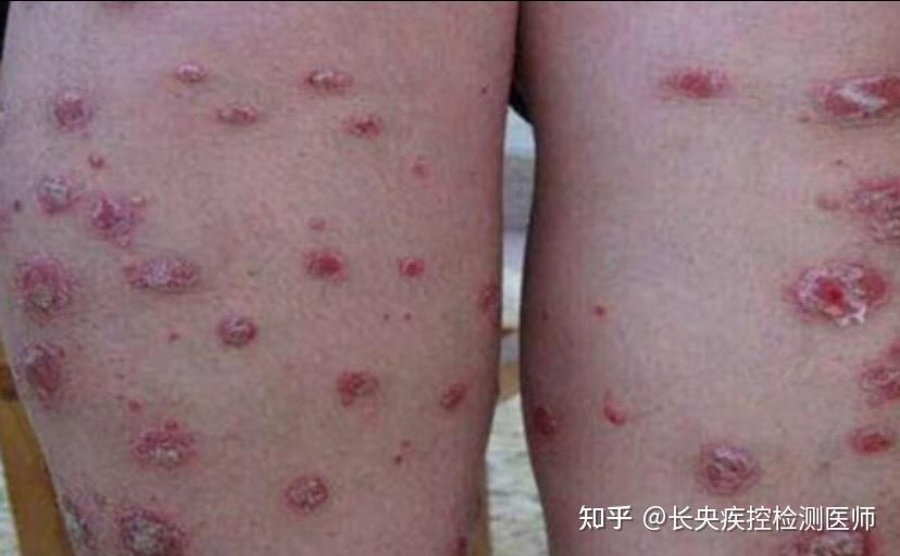 梅毒一期硬下疳、二期梅毒疹的特点 - 知乎